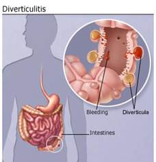 diverticulitis