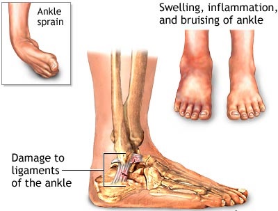 Image result for back ankle pain