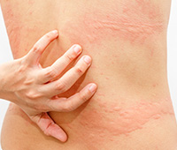 What is Urticaria Ayurvedic treatment